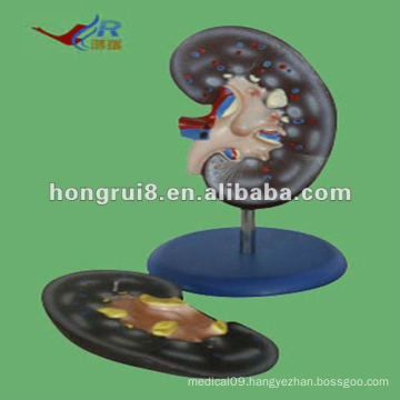 ISO 2012 Human Kidney Anatomy Model( 2 parts), anatomy function model HR-310-2